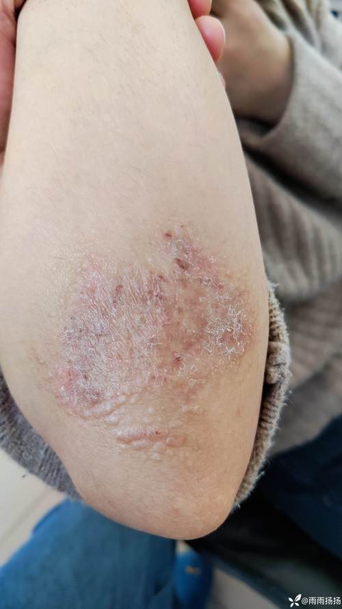 瘙痒症状