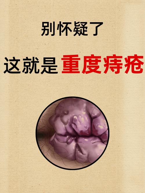痔疮加重便秘