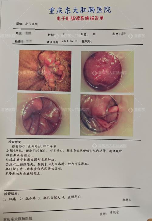 痔疮肿胀
