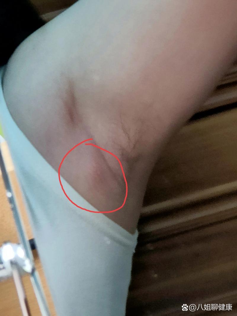 肿起小块肉
