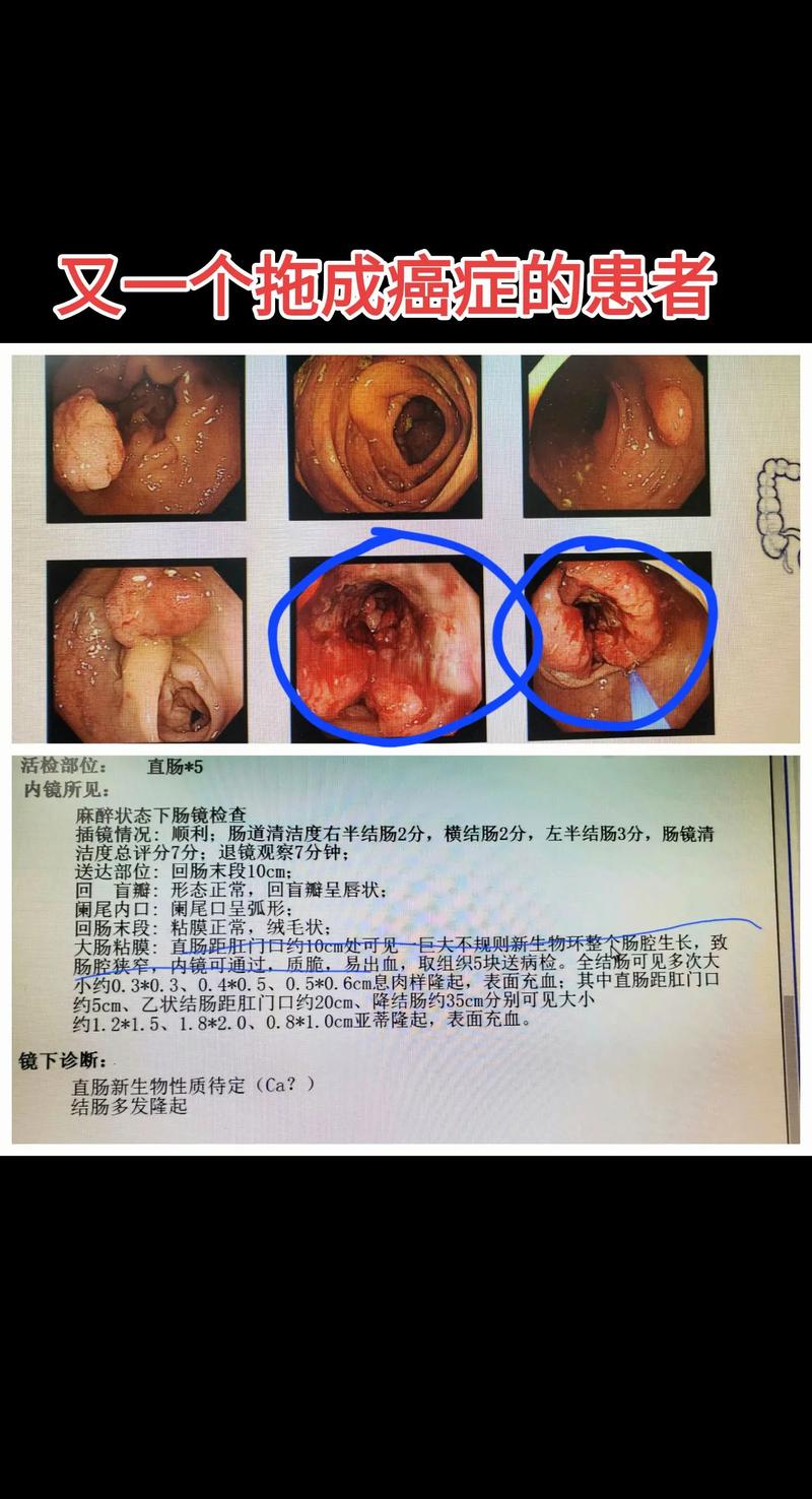 直肠息肉