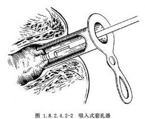 上海套扎术