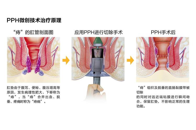 PPH技术